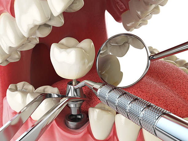 Best Emergency Dentist for Knocked-Out Tooth in Umatilla, OR